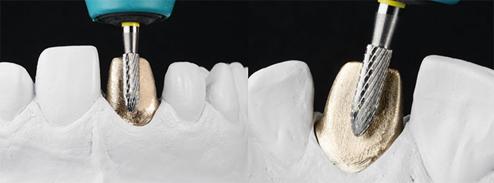 Ausbetten von Dentalkeramik