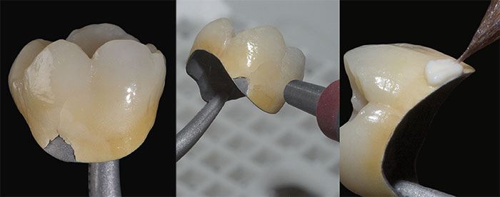 Dentalkeramik Reparaturopaker