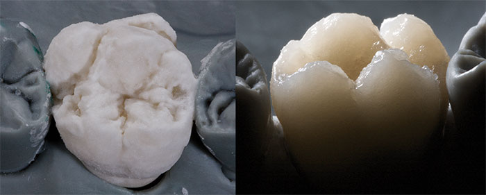 Unica Dentalkeramik Schichtung